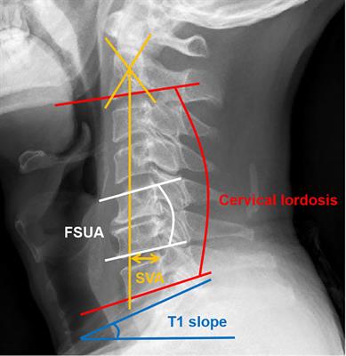 The fatty infiltration into cervical paraspinal muscle as a predictor of postoperative outcomes: A controlled study based on hybrid surgery